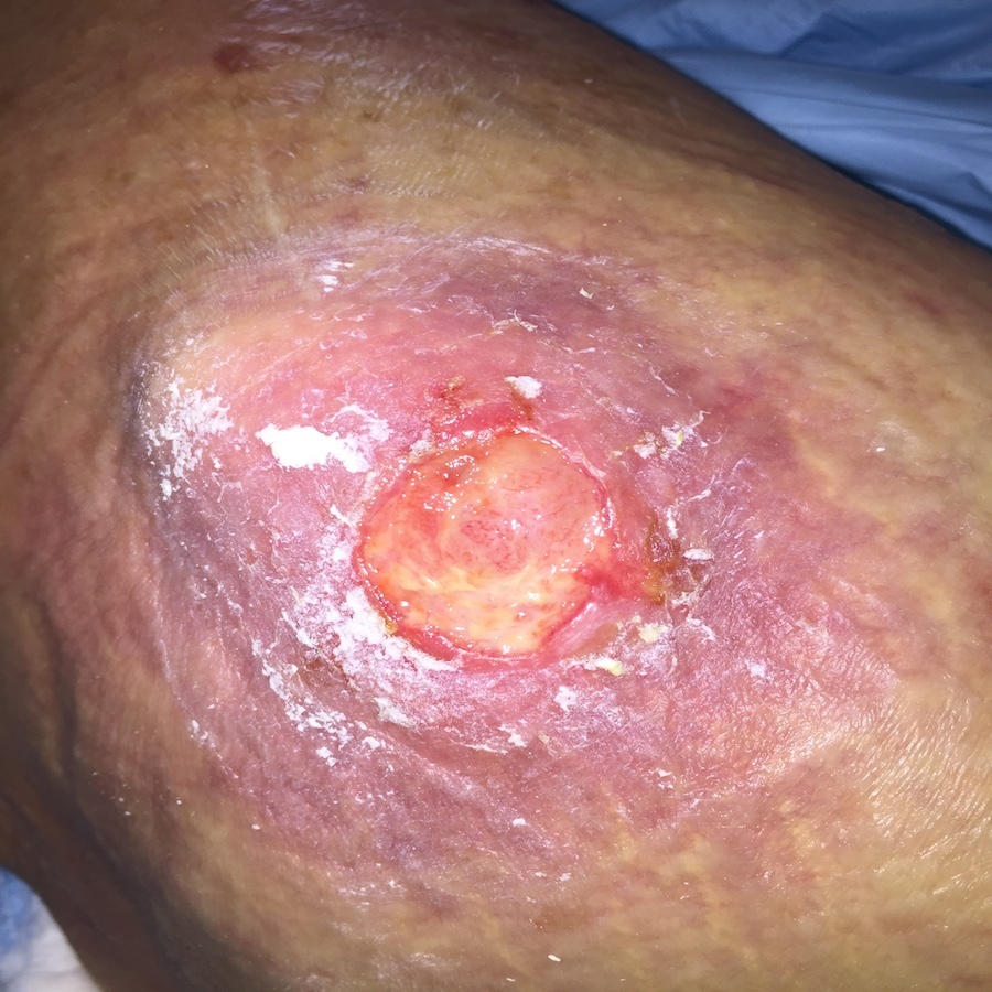 Fig10-4ShallowStage3Ulcer-SuperficialSlough-SurroundingCellulitis.JPG