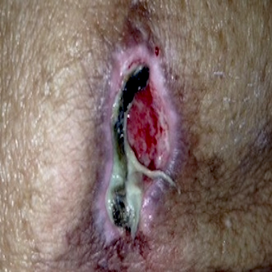Fig10.8.UnstageableSacralUlcer